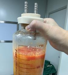 阜宁水动力吸脂手术要做多久？